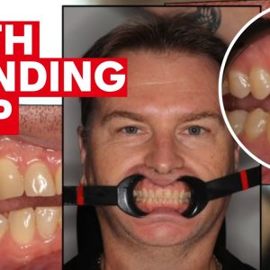 Teeth grinding can be caused by stress, airway issues and medication | 7NEWS