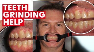 Teeth grinding can be caused by stress, airway issues and medication | 7NEWS